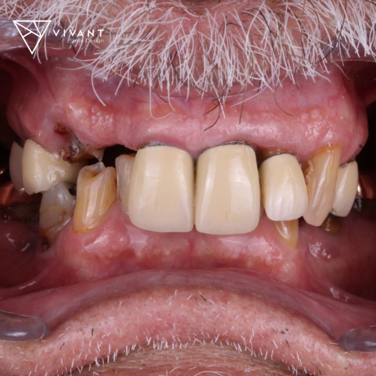 Vivantsmiledesinglosalgodonescaso-implants6-768x768