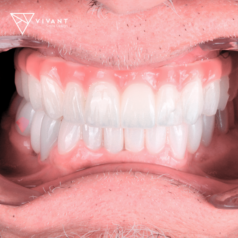 Vivantsmiledesinglosalgodonescaso-implants7-768x768